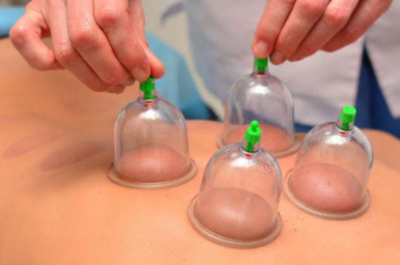 cupping at bodyworks clinic