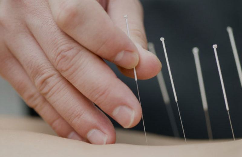 dry needling at bodyworkx clinic