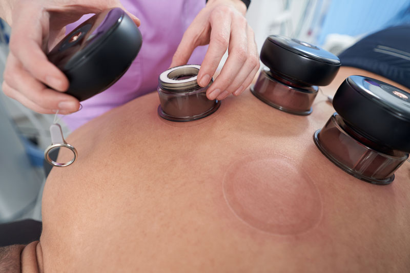 cupping therapy in Ringwood and Eltham at Bodyworkx