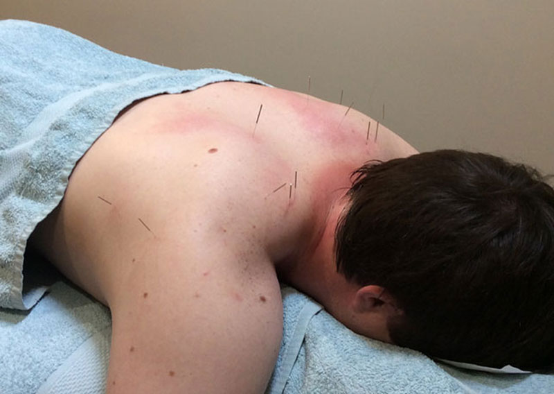 dry needling treatment Ringwood and Eltham